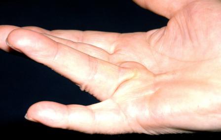 boka ínszalagok sérüléseinek kezelése)