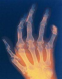 A térdízületi gyulladás típusai