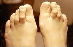 a nagy lábujj ízületének gyulladása okoz