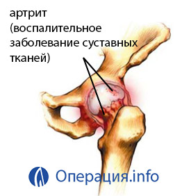 a könyökízületek artrózisa 1 fok