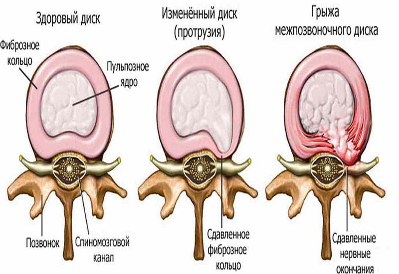 mellkasi osteochondrozis fájdalomcsillapítás)