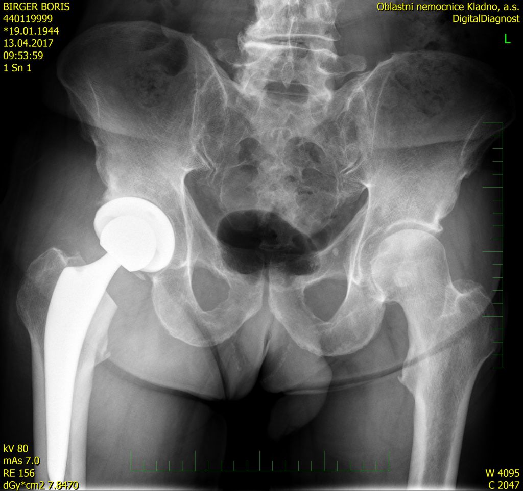 a csípőízület akut artrózisa