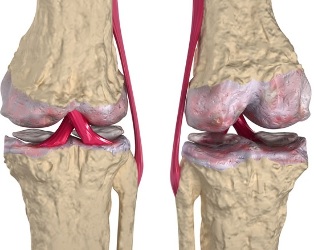 könyökbetegség tünetei bicillin 3 ízületi gyulladások esetén