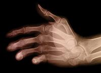 Mi az az artrózis? | BENU Gyógyszertárak