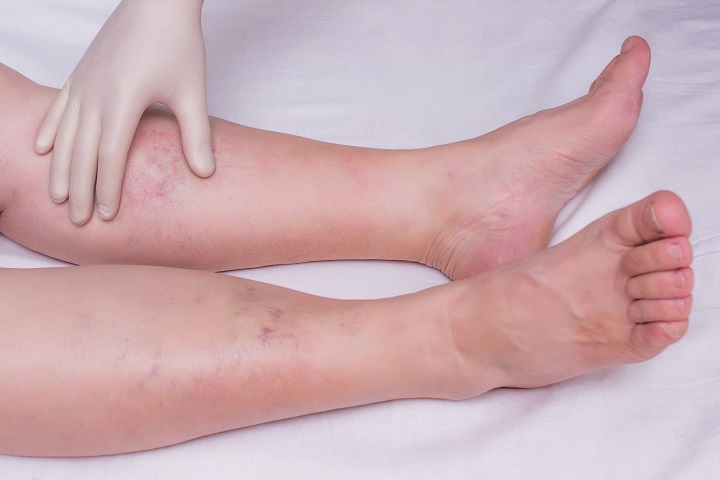 végtag duzzanat ízületi fájdalom)