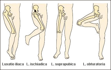 Csípőizületi porckopás | Dr. Gergely Zsolt