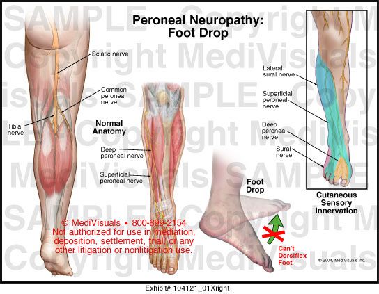 a lábfej lábujjízületének ízületi kezelése)