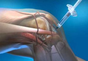 artrózis tünetei kezelése)