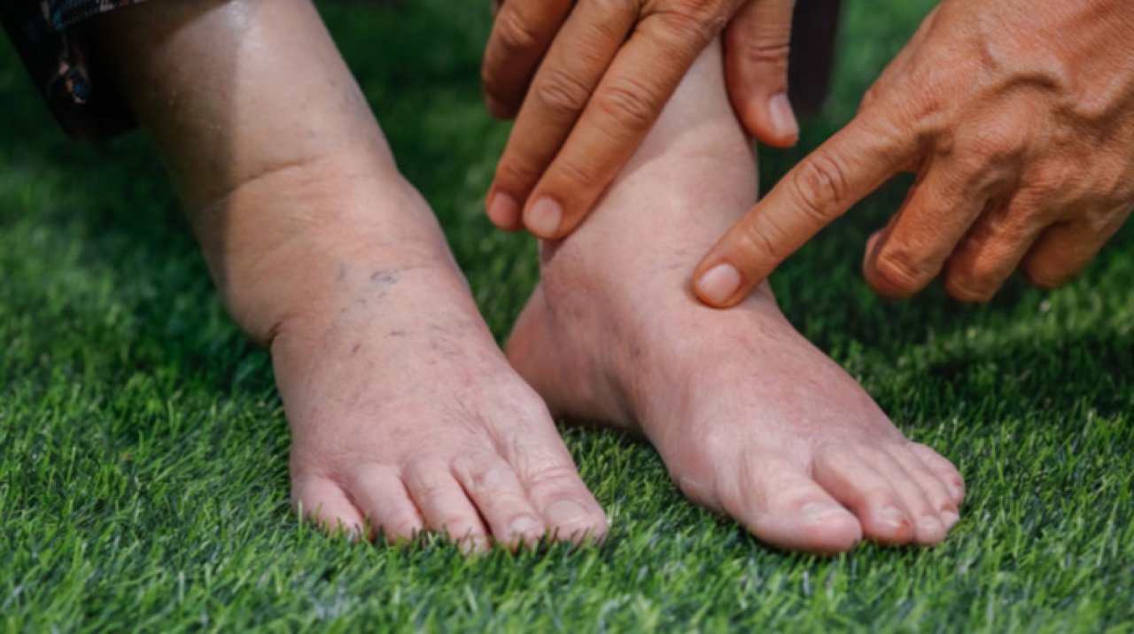 boka duzzanat cukorbetegség esetén