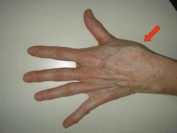 ha a bal kéz ízülete fáj