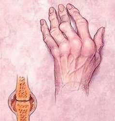 reggel felébredtem, az ízület fáj