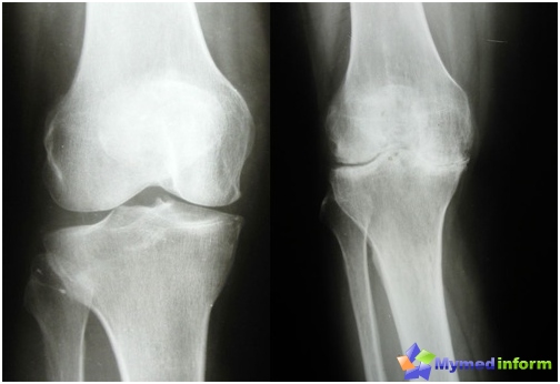 térdízületi gyulladás kezelése saki sárral