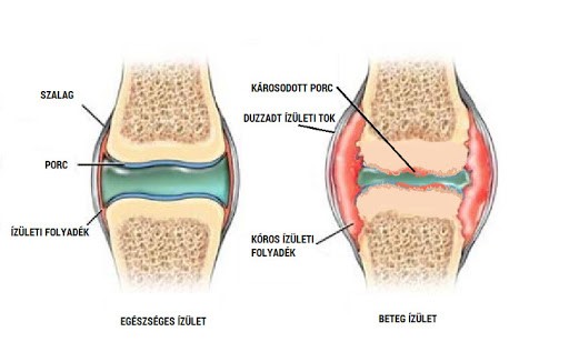 ízületi mobilitás artrózissal)